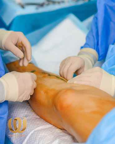 علاج انسداد الأوعية الدموية في القدم